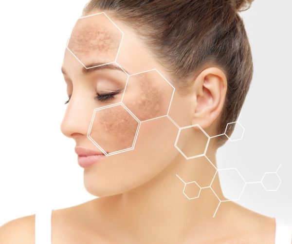 Hyperpigmentation Treatment in Newnan, GA Hyperpigmentation Treatment in Newnan, GA | Pure Bella Aesthetic Boutique